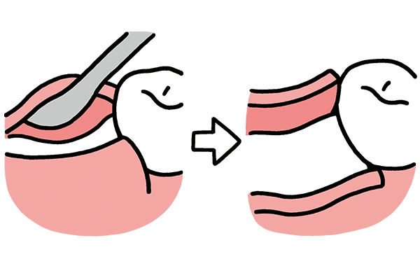 歯茎と骨を剥離